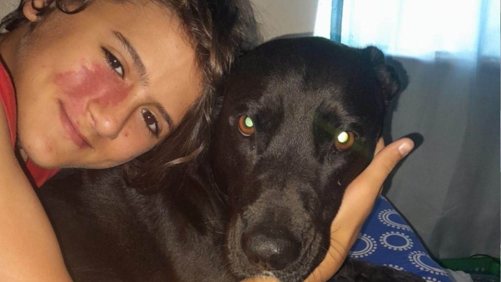 A smiling child with a large red birthmark on their cheek hugs a black dog closely while lying on a blue-patterned blanket near a window with sheer curtains.