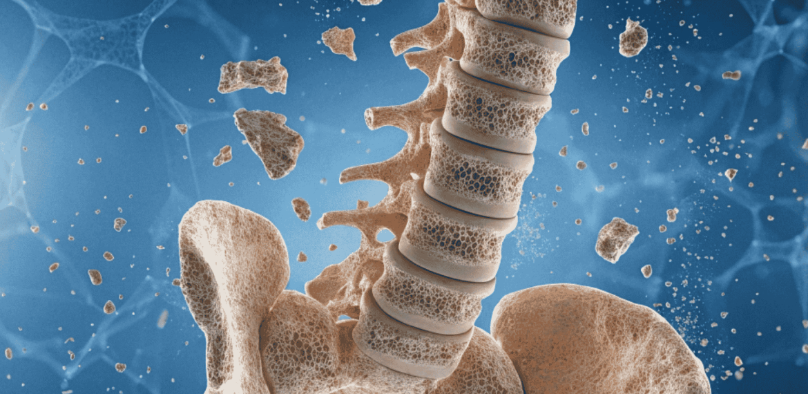 A medical illustration of a human spine and pelvis showing porous, brittle bone structure with fragments breaking away.