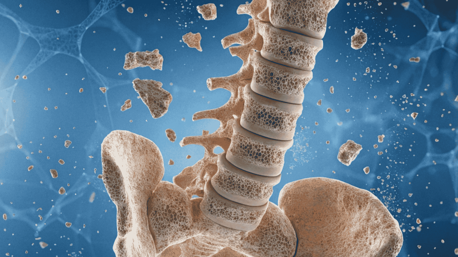 A medical illustration of a human spine and pelvis showing porous, brittle bone structure with fragments breaking away.
